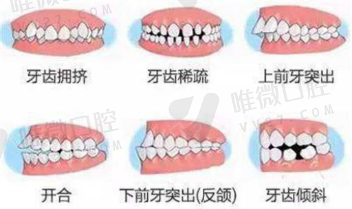 固定牙齿和活动假牙区别,如何固定牙齿(图1)